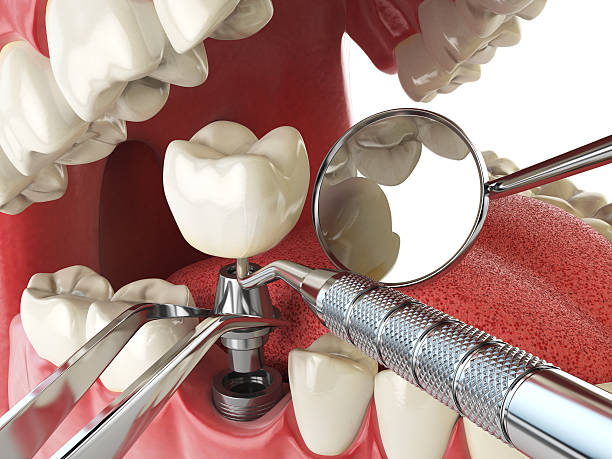 Best Knocked-Out Tooth (Avulsed Tooth) Treatment in Ault, CO